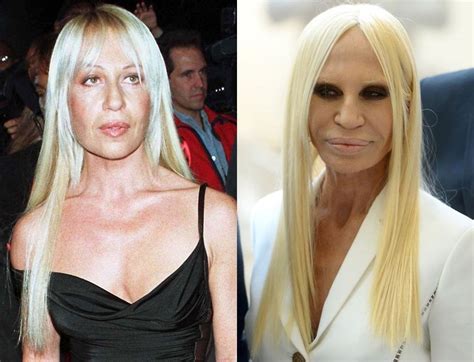 chirurgia plastica donatella versace|donatella versace before surgery.